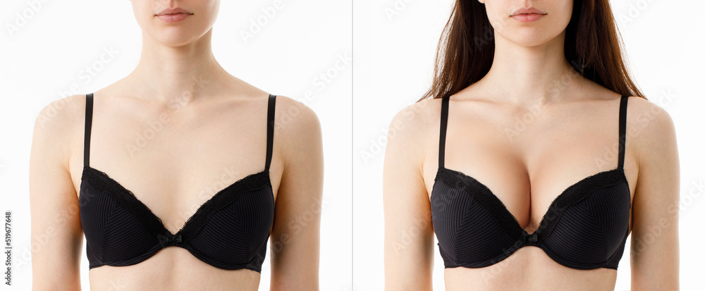 Bust of a woman before and after breast augmentation surgery. Woman in bra  with different sizes of breast on white background. Plastic surgery  concept. Stock Photo