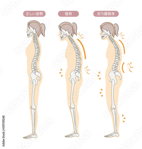 正しい姿勢と歪んだ姿勢（猫背や反り腰）のわかりやすいイラスト