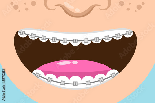 Tooth with braces vector illustration