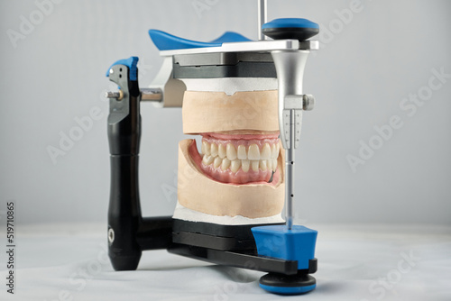 Dental photo of the articulator and two dental prostheses in the occlusion for accuracy and measurements.