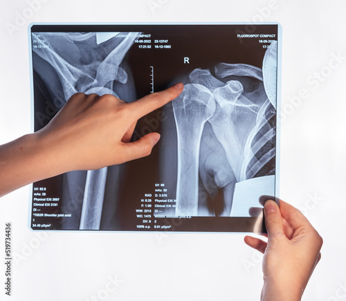 Forefinger pointing to trauma at arm X-ray image. Acromion, acromial end fracture. Doctor showing shoulder, clavicle overuse injury. Medical conditions identification and diagnosis. High quality photo photo