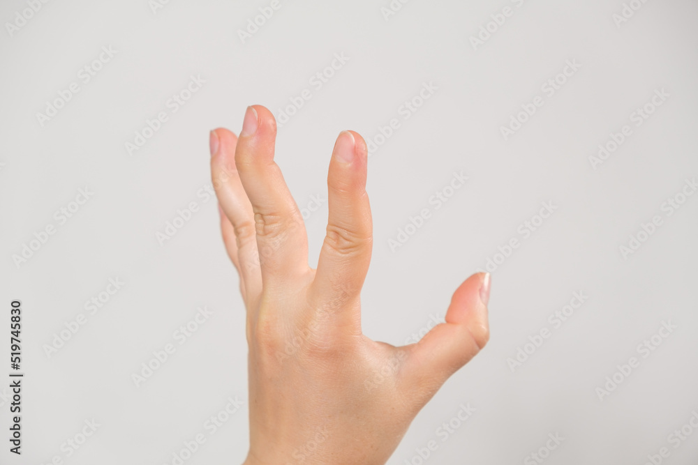 A human hand with an unnaturally bent joint. Ankylosis of the joints of the hand A human hand with an unnaturally bent joint. Ankylosis of the joints of the hand