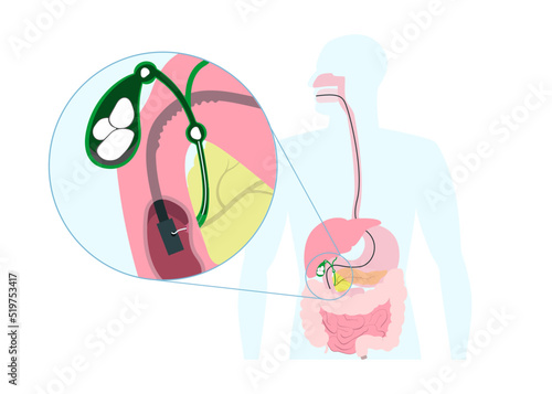Endoscopic removal of gallbladder stone through mouth, stomach, to bile duct. Medical operation infographics.