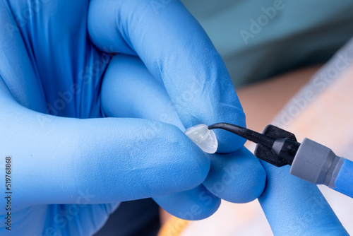 Cementation of laminate ceramic veneers