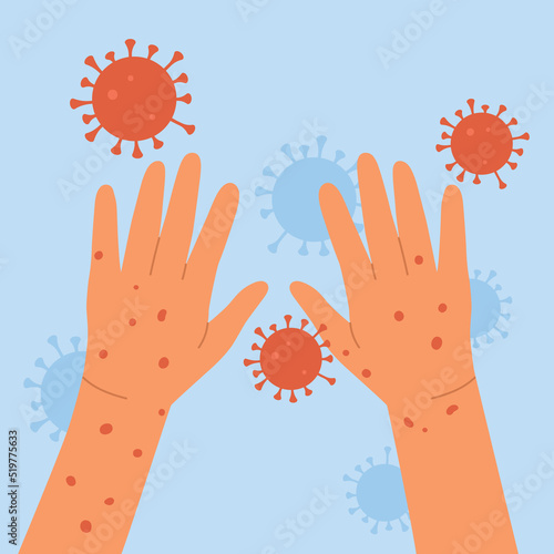 Monkeypox virus. Human hands with monkeypox. Skin infection concept. An outbreak of a smallpox pandemic. Vector illustration in cartoon style. Isolated on blue background.