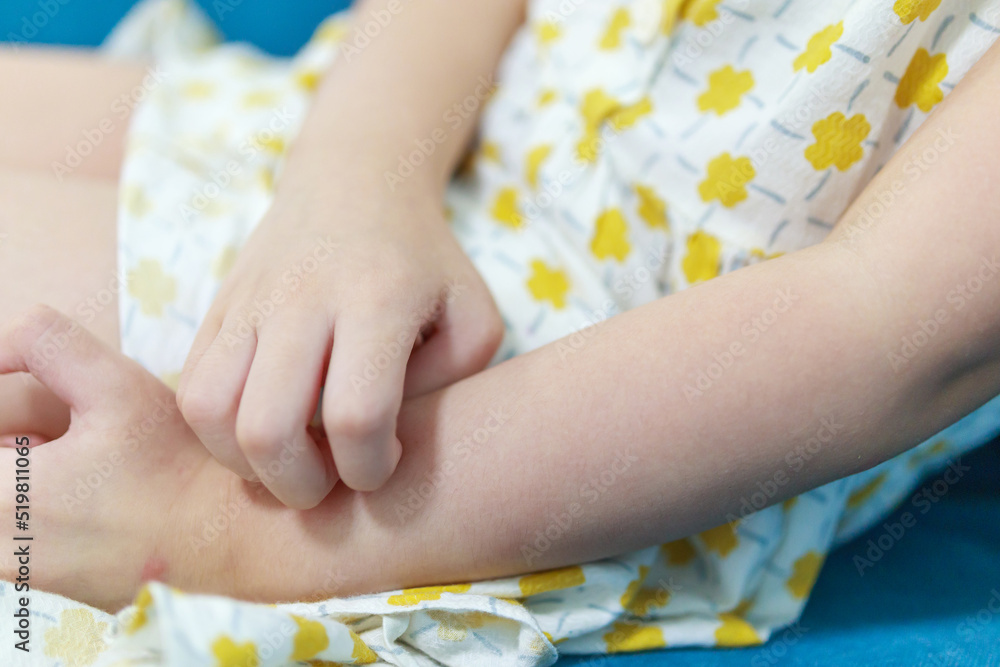 Little girl has skin rash allergy itching and scratching on her arm Little girl has skin rash allergy itching and scratching on her arm