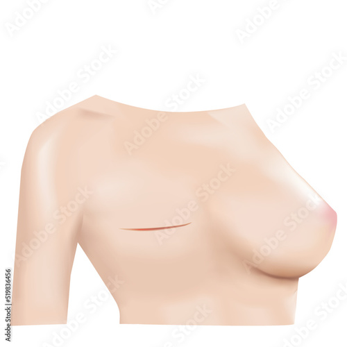 Breast cancer surgery scars, lumpectomy, Breast cancer removal, Front view 3D Realistic design Vector.