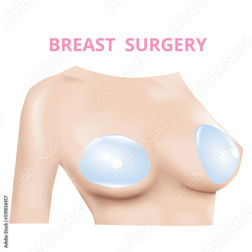 Breast implant, Silicone insert, Plastic surgery, 3D Realistic design Vector.