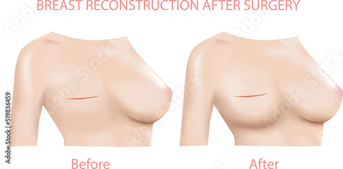Women Breast reconstruction Before and after surgery, Front view 3D Realistic design Vector. photo