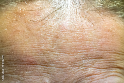 Фотография The forehead of a woman with problematic skin