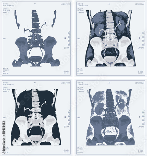 set vector x-ray of human abdomen with pelvic bone and spine. Medical diagnostics of the digestive system and kidneys
