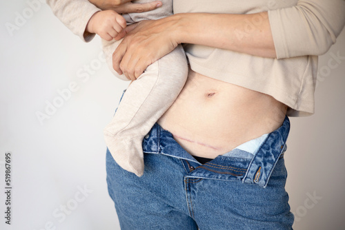 Mom's abdomen after cesarean section. Scar seam. A young mother holds the baby in her arms. Real motherhood. Lifestyle