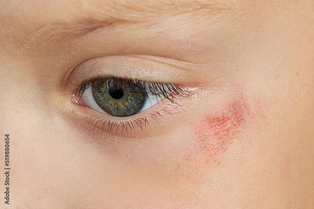 Abrasion on the face of a girl's child. Wound under the eye closeup
