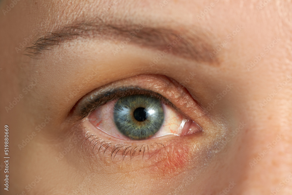 Obraz premium Peeling and swelling on the eyelid of the human eye.
