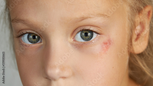 Abrasion on the face of a girl's child. Wound under the eye close-up. The concept of treatment of childhood trauma