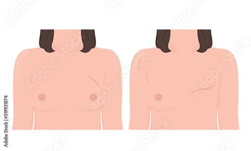 Mastectomy breast cancer lymph node surgery