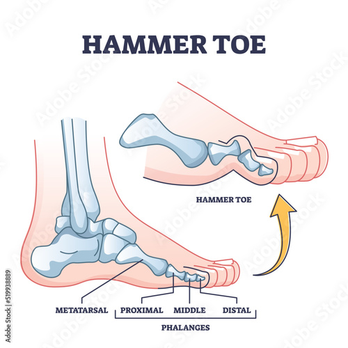 Hammer toe medical problem anatomy with foot phalanges deformation outline diagram. Labeled educational scheme with bent metatarsal, proximal, middle and distal bones deformity vector illustration.