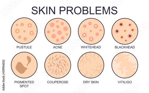 Different types of skin problems vector illustrations set. Signs of different kinds of dry or oily skin problems, acne, pigmented spots isolated on white background. Health, skincare concept photo