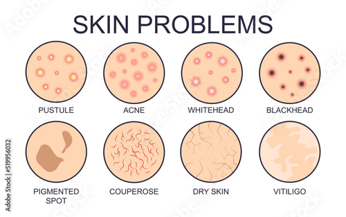 Different types of skin problems vector illustrations set. Signs of different kinds of dry or oily skin problems, acne, pigmented spots isolated on white background. Health, skincare concept