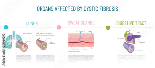 Infographics of the main organs affected by cystic fibrosis photo