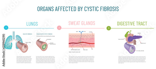 Infographics of the main organs affected by cystic fibrosis