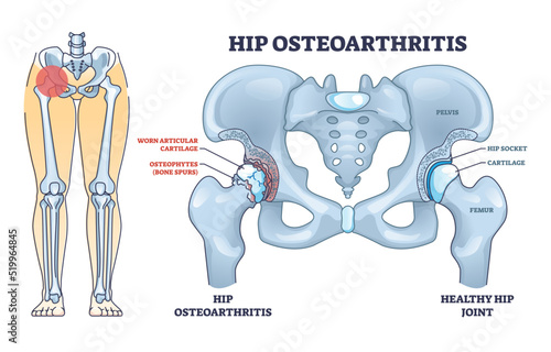 Hip osteoarthritis bone disease with painful skeletal spurs outline diagram. Labeled educational scheme with osteophytes damaged pelvis and femur anatomy vector illustration. Inflammation illness.