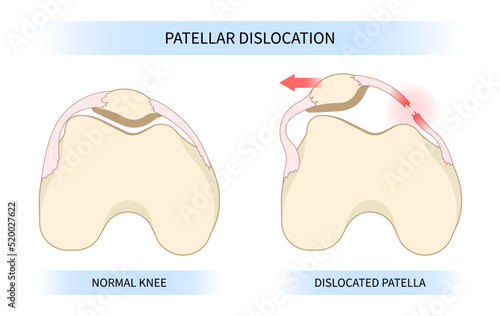 The patellar dislocated and subluxation patella dysplasia with Painful Joint photo