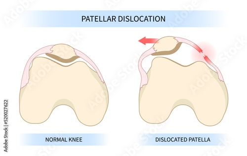 The patellar dislocated and subluxation patella dysplasia with Painful Joint