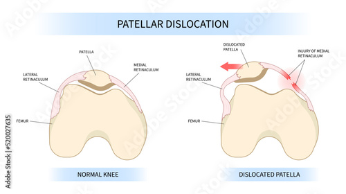 The patellar dislocated and subluxation patella dysplasia with Painful Joint