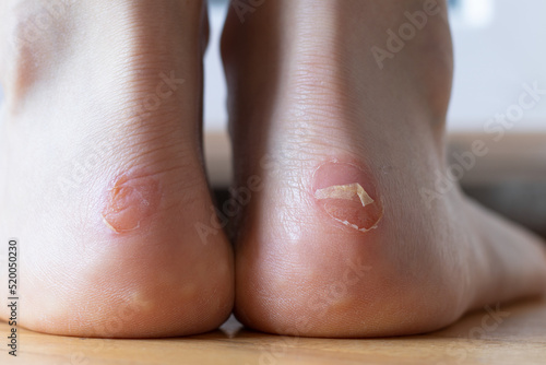 Blister on a barefoot female heel. A closeup. Painful dry callus on a woman's feet skin. Dermatology problem, uncomfortable skin condition. photo