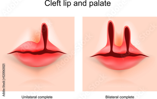 Cleft lip and cleft palate photo