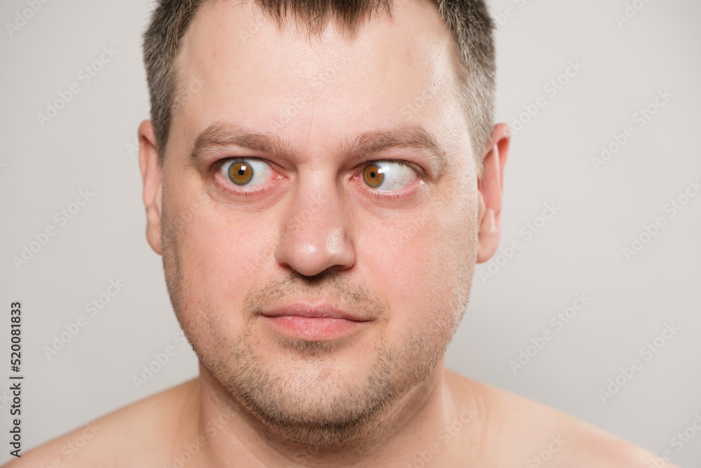 Fototapeta premium A man with strabismus squints his eyes on a white background.