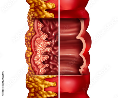 Crohn's Disease and Crohn syndrome illness or crohns illness and healthy colon as a medical concept with inflammation symptoms causing obstruction photo