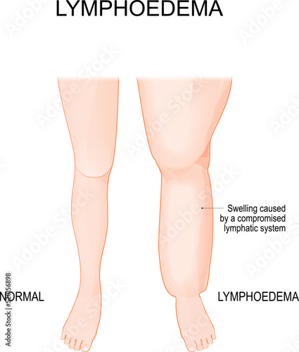 Lymphedema. Lower extremity lymphatic obstruction. Comparison and difference photo
