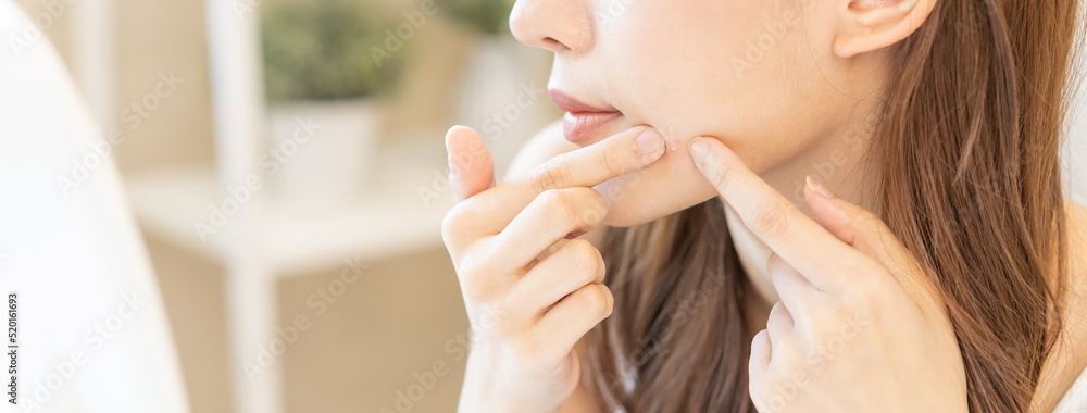 Εκτύπωση καμβά Dermatology, puberty asian young woman, girl looking into mirror, allergy when wear mask and cosmetic, show squeezing pimple spot for removing from face