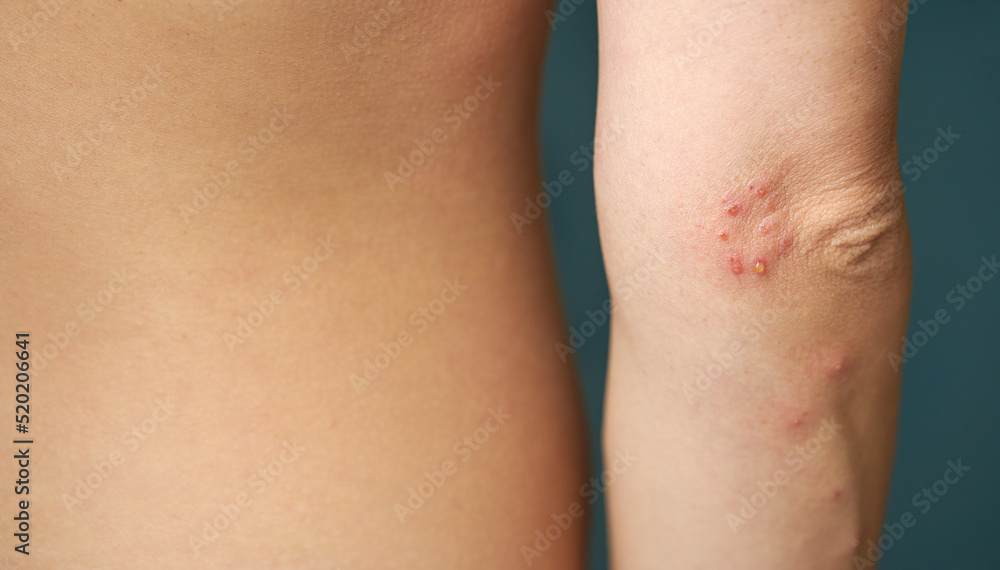 Φωτογραφία Insect bite marks on a woman hand