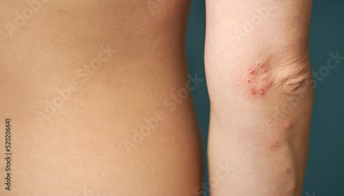 Photos Insect bite marks on a woman hand