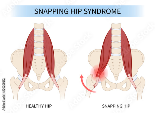 labral tensor and hip muscle pain coxa saltans flexor stretch rectus bursae Intra groin broken strain iliacus psoas torn major band Joint tear thigh tract femur tendon Injury greater trauma Labrum photo