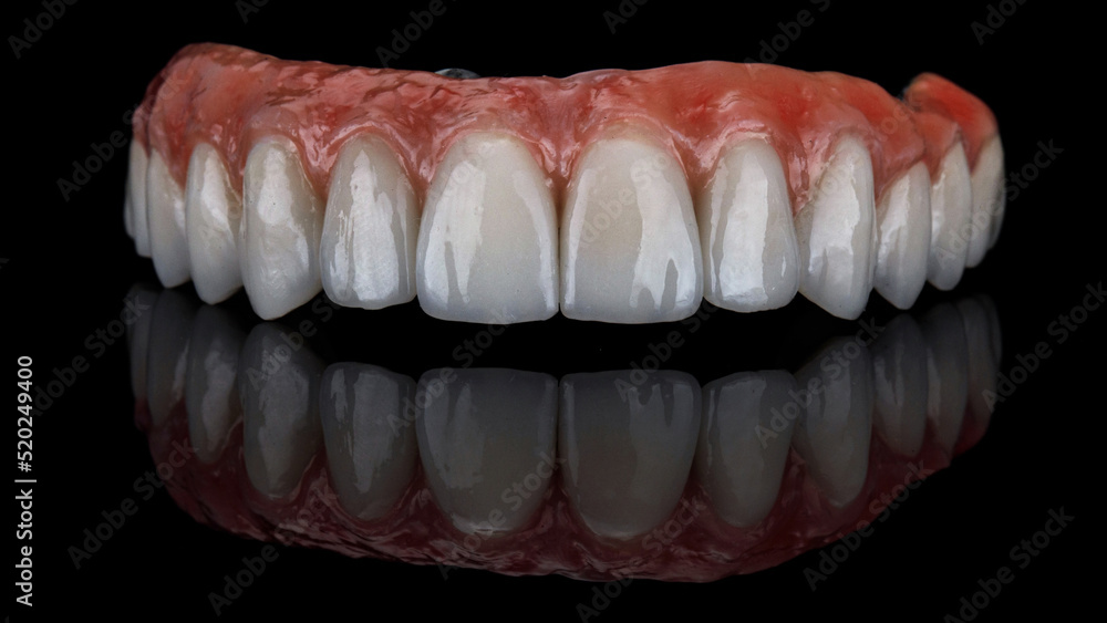 Obraz premium dental prosthesis of the upper jaw made of ceramic and titanium with a natural gum on black glass with reflection