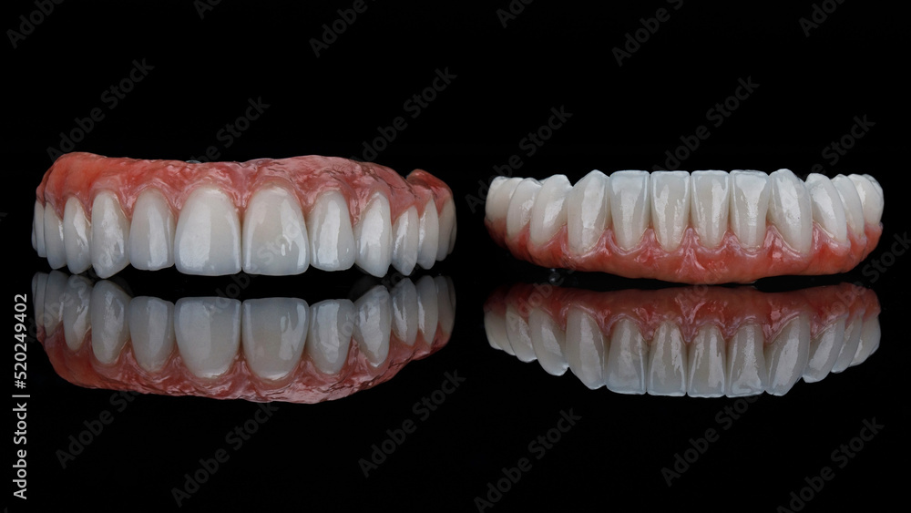 two excellent dental prostheses made of ceramic and titanium with natural gums on black glass with reflection two excellent dental prostheses made of ceramic and titanium with natural gums on black glass with reflection