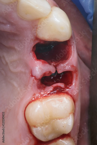 two extracted teeth before implantation