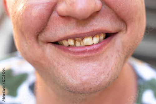 Fotografia Yellow crooked teeth of a smoker, close-up