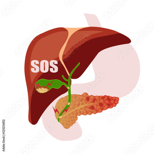 Illustration showing Inflamed pancreas, gallstones blocking pancreatic duct Vector illustration.