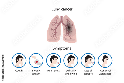 Lung cancer and its symptoms photo
