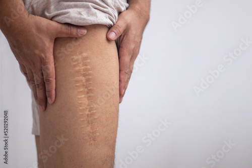 Scar caused by leg surgery