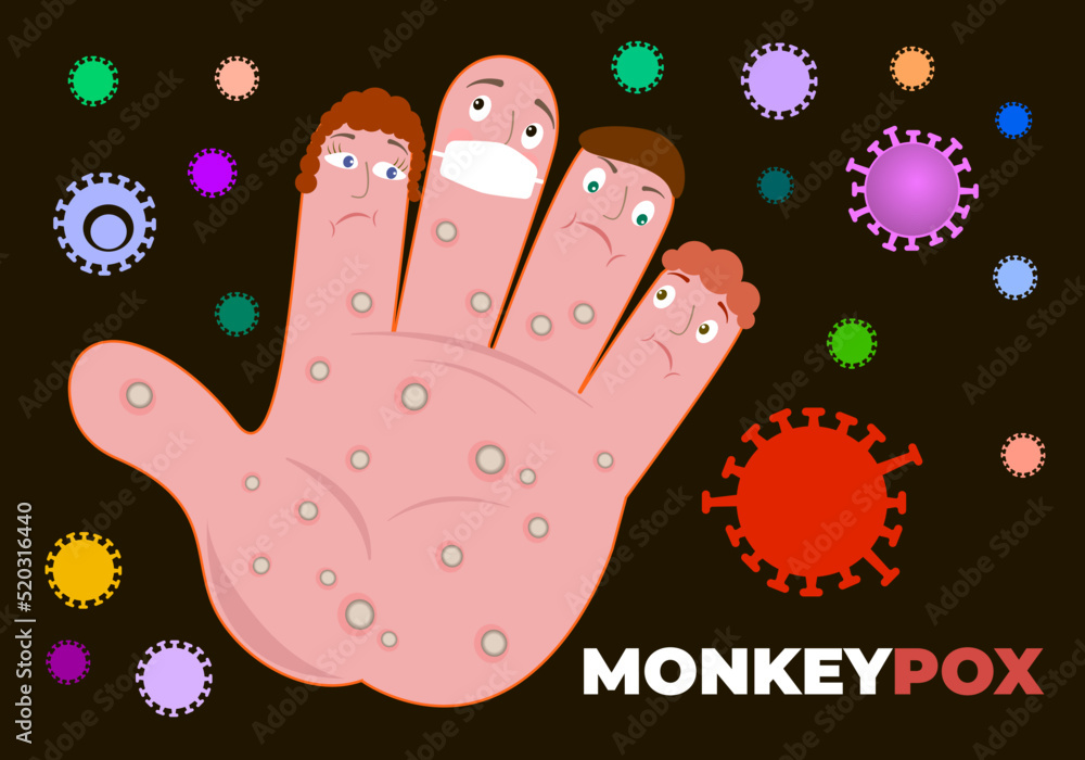 An outbreak of the monkey pox virus. Disease prevention banner, design.