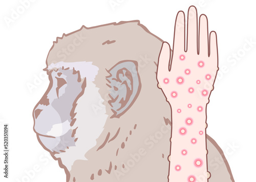 サル痘のイメージイラスト