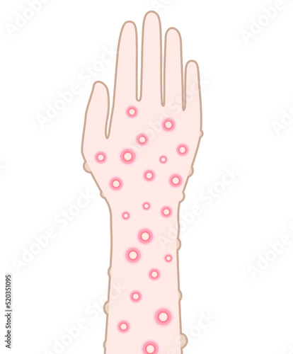 サル痘のイメージイラスト