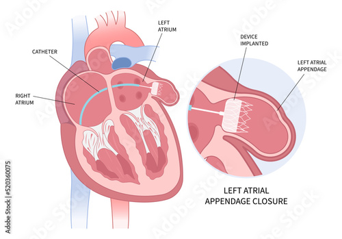 Left arterial appendage closure device implant to heart for treatment atrial fibrillation photo