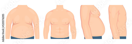 Vector illustration of gynecomastia in men before and after treatment. Human chest in a half-turn (front and side view). For advertising cosmetic plastic procedures
